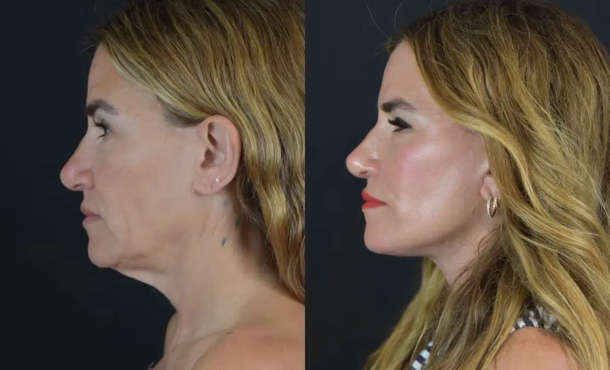 alli webb facelift side profile