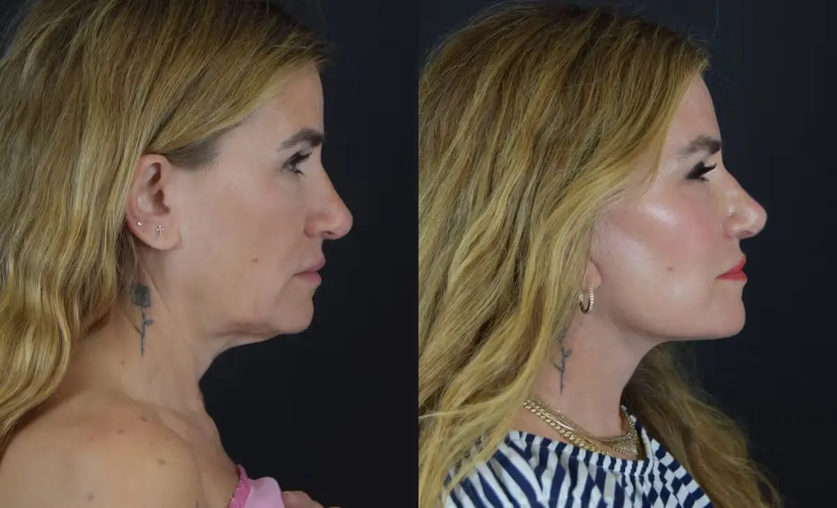 alli webb facelift photos
