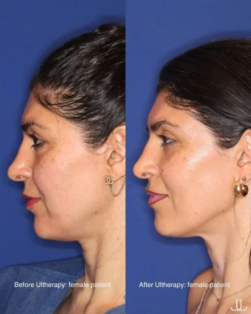 ultherapy before and after